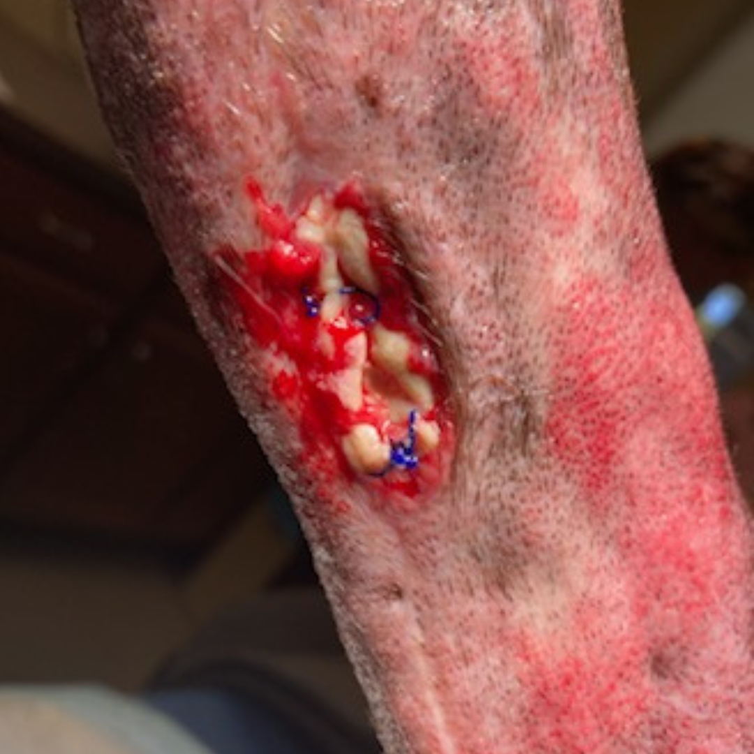 Vetlen case study Torn Left Hind Achilles image - 6