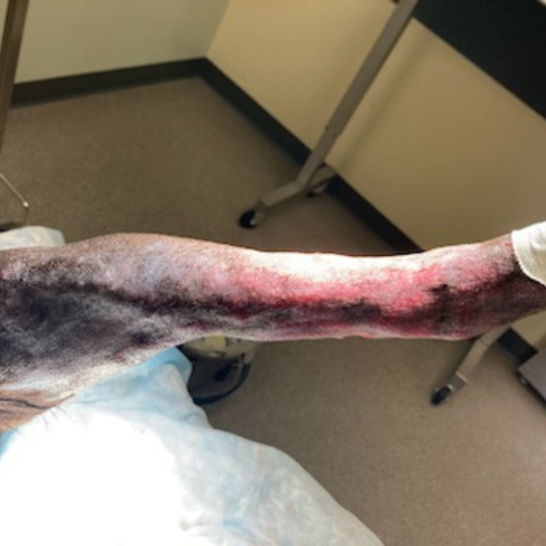 Vetlen case study Torn Left Hind Achilles image - 6