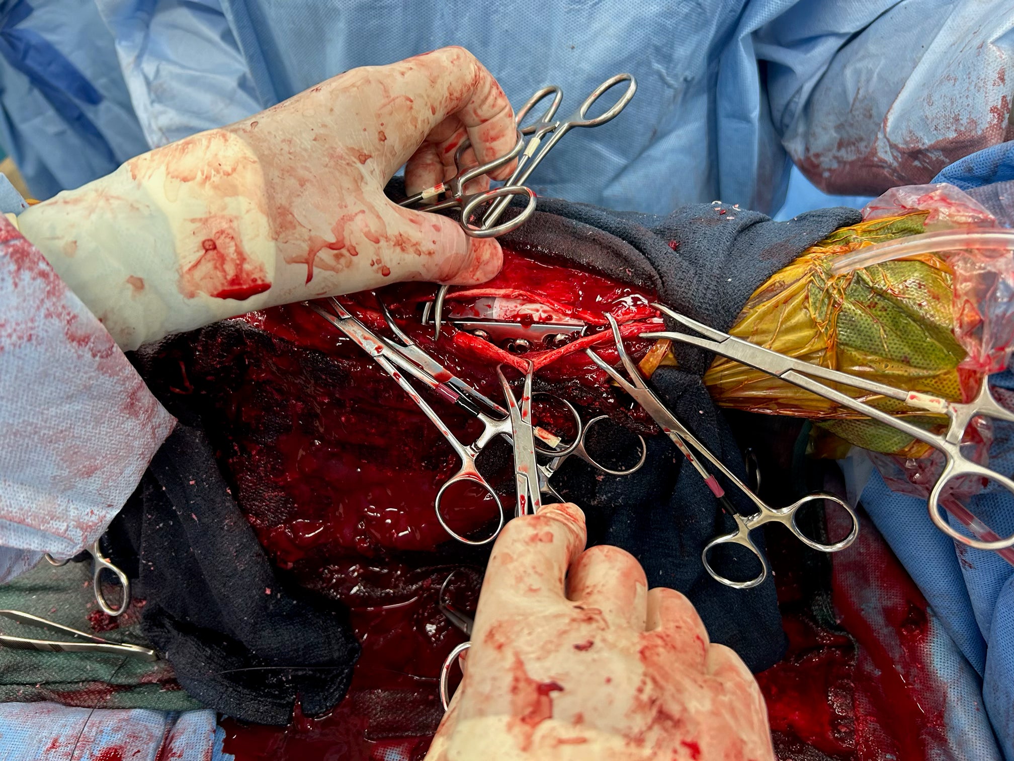 Vetlen case study Fetlock Arthrodesis Due To Degenerative Arthritis image - 3